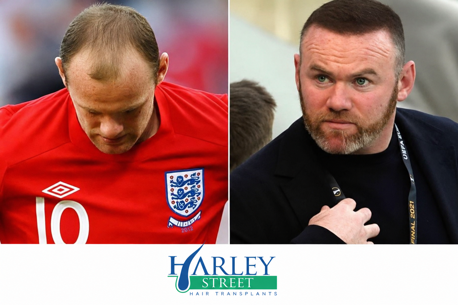 Image of Wayne Rooney before and after FUE hair transplant 