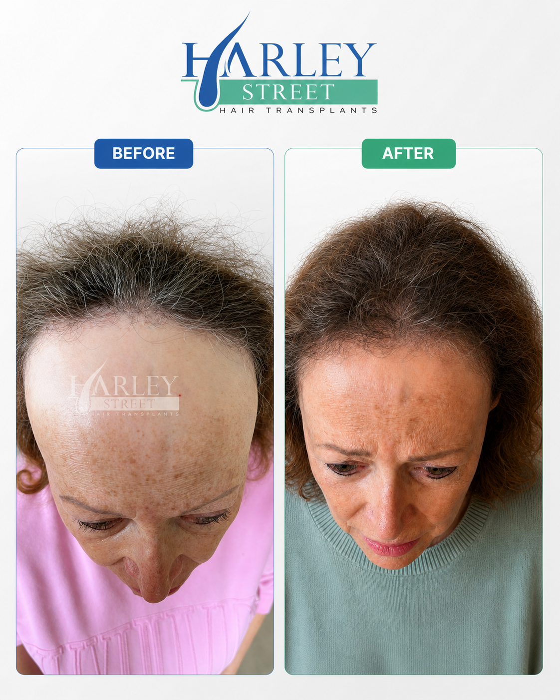 Hair transplant before and after patient result