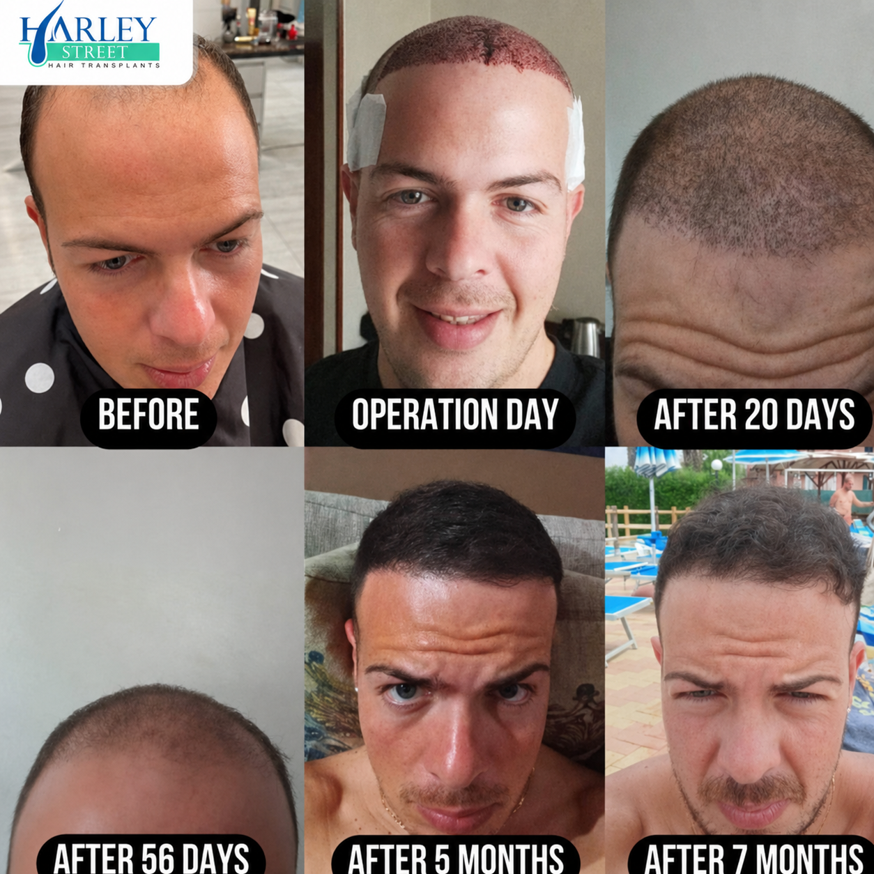 Kev hair transplant before and after results