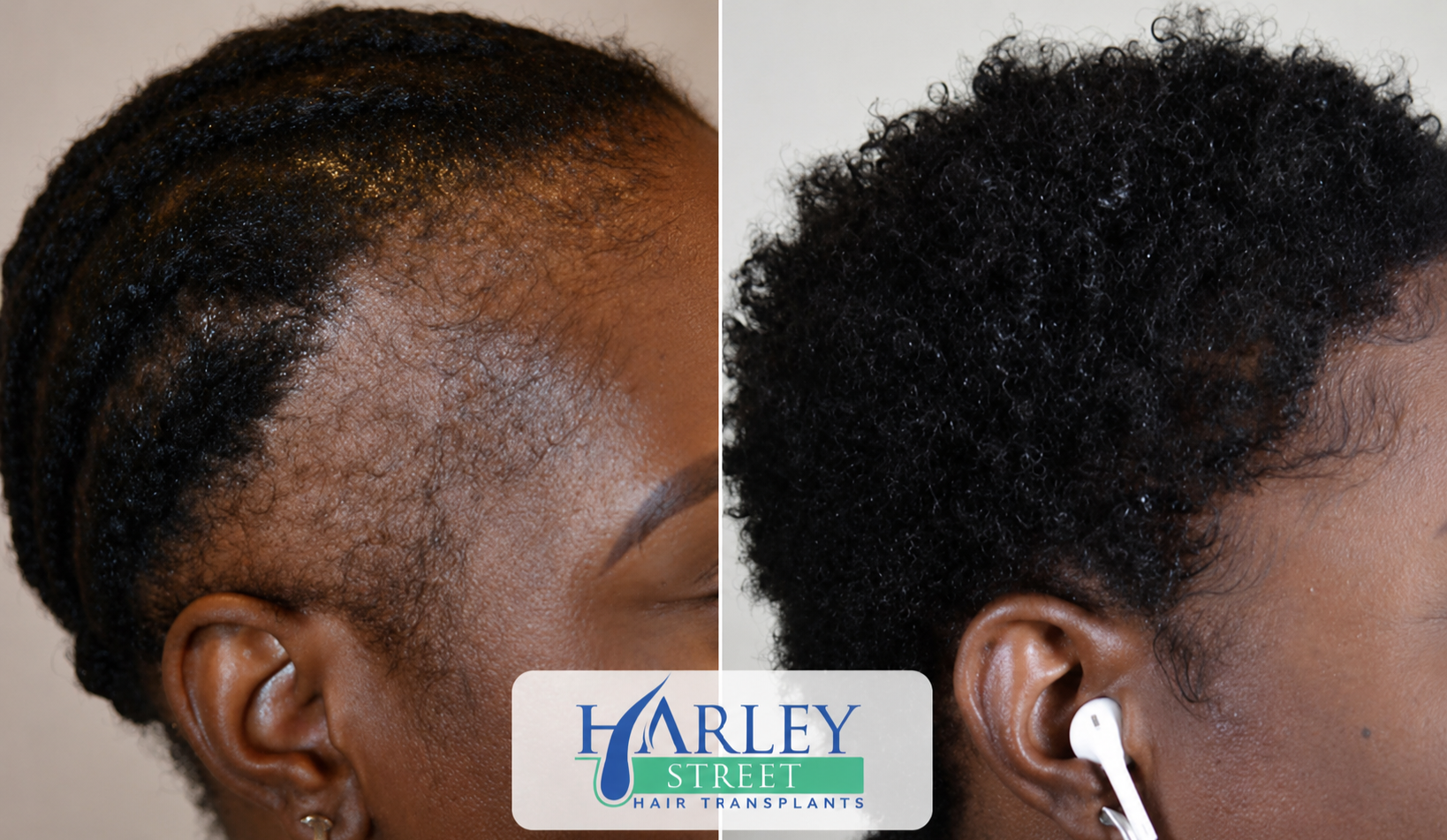 Afro-textured hair transplant before and after result