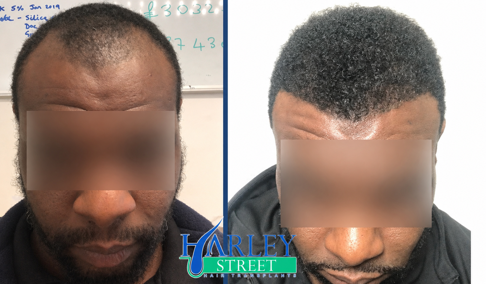 Kelvin hair transplant before and after results