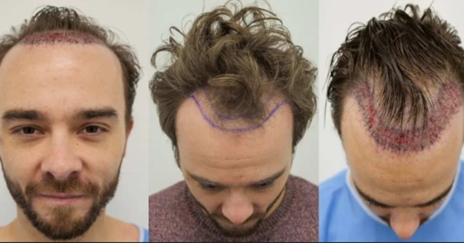 Hair transplant progression from several angles