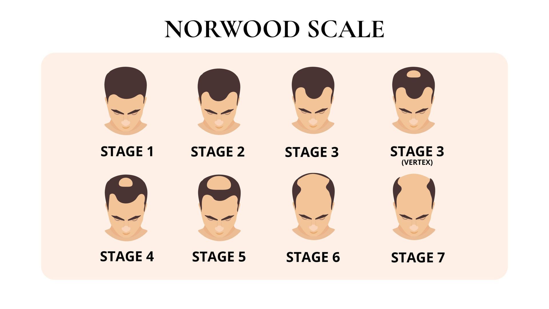 Norwood scale stages of male pattern hair loss