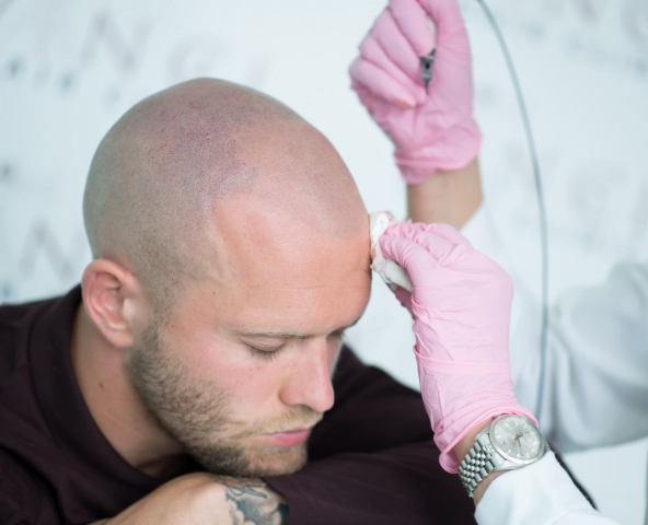 Scalp micropigmentation hairline result