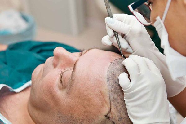 Hair Transplant Procedure