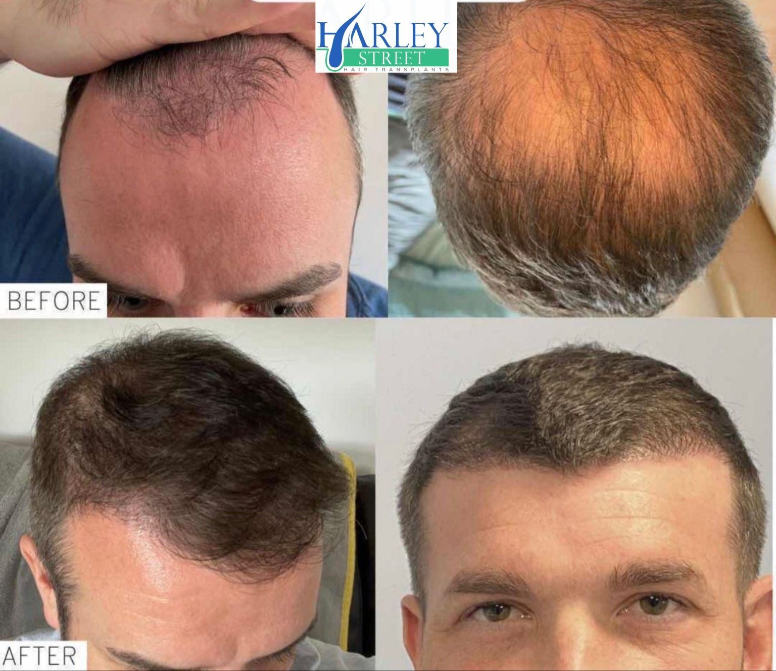 Danny hair transplant before and after results