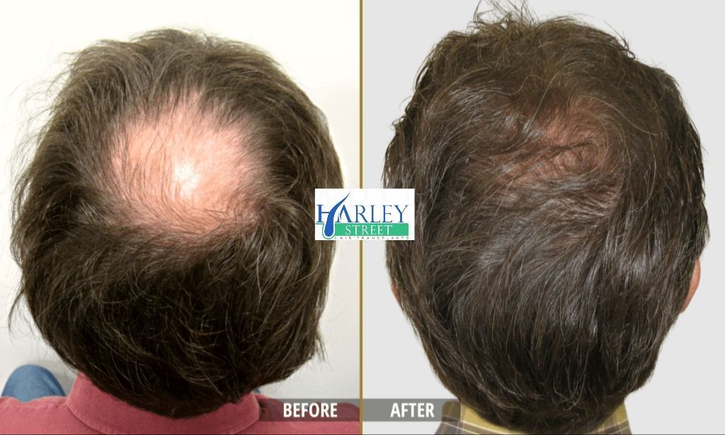 Tommy hair transplant before and after results