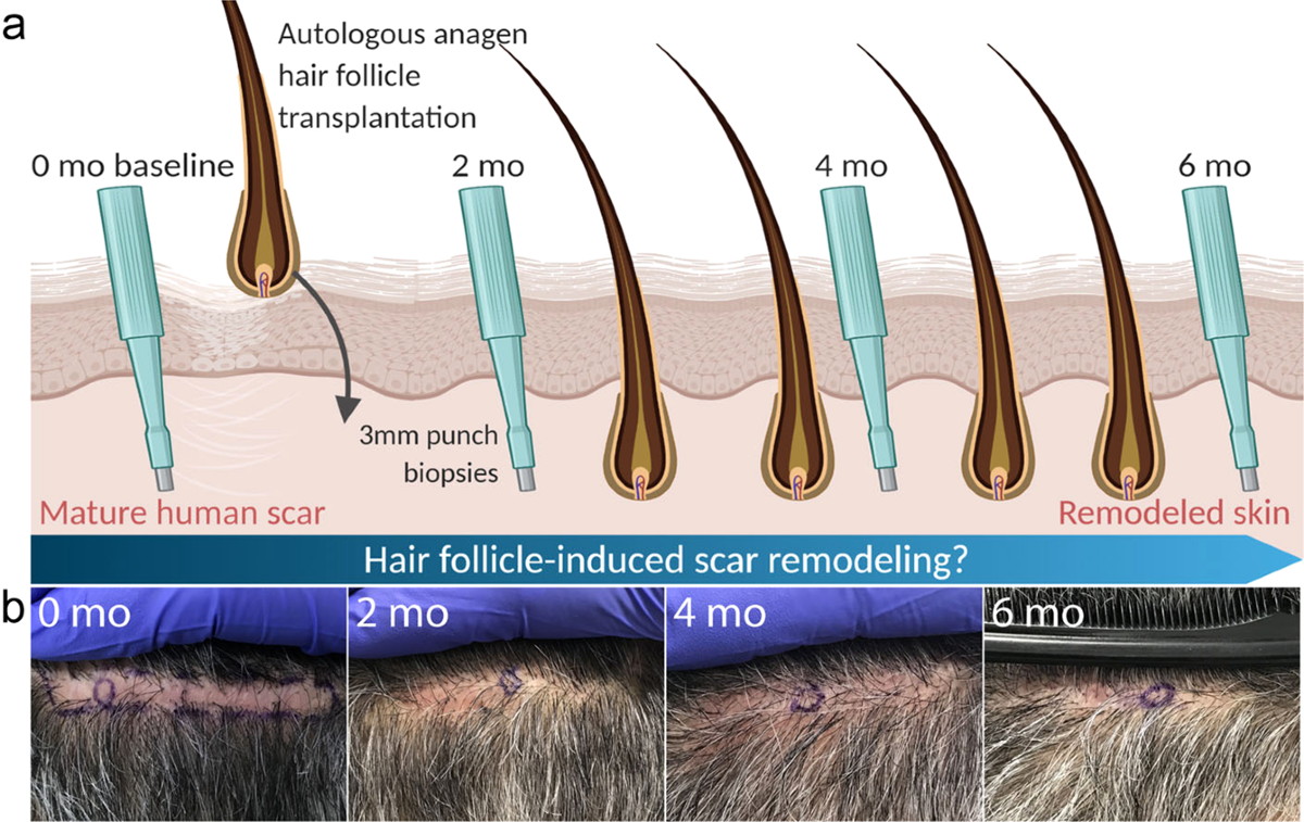 Diagram explaining hair transplantation into scar tissue