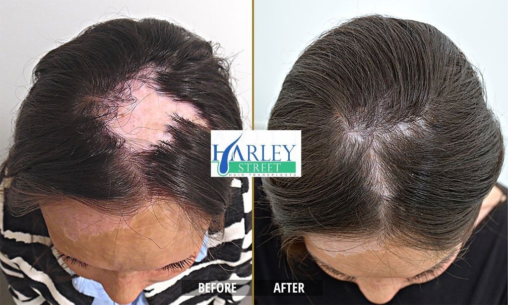 Helen hair transplant before and after results