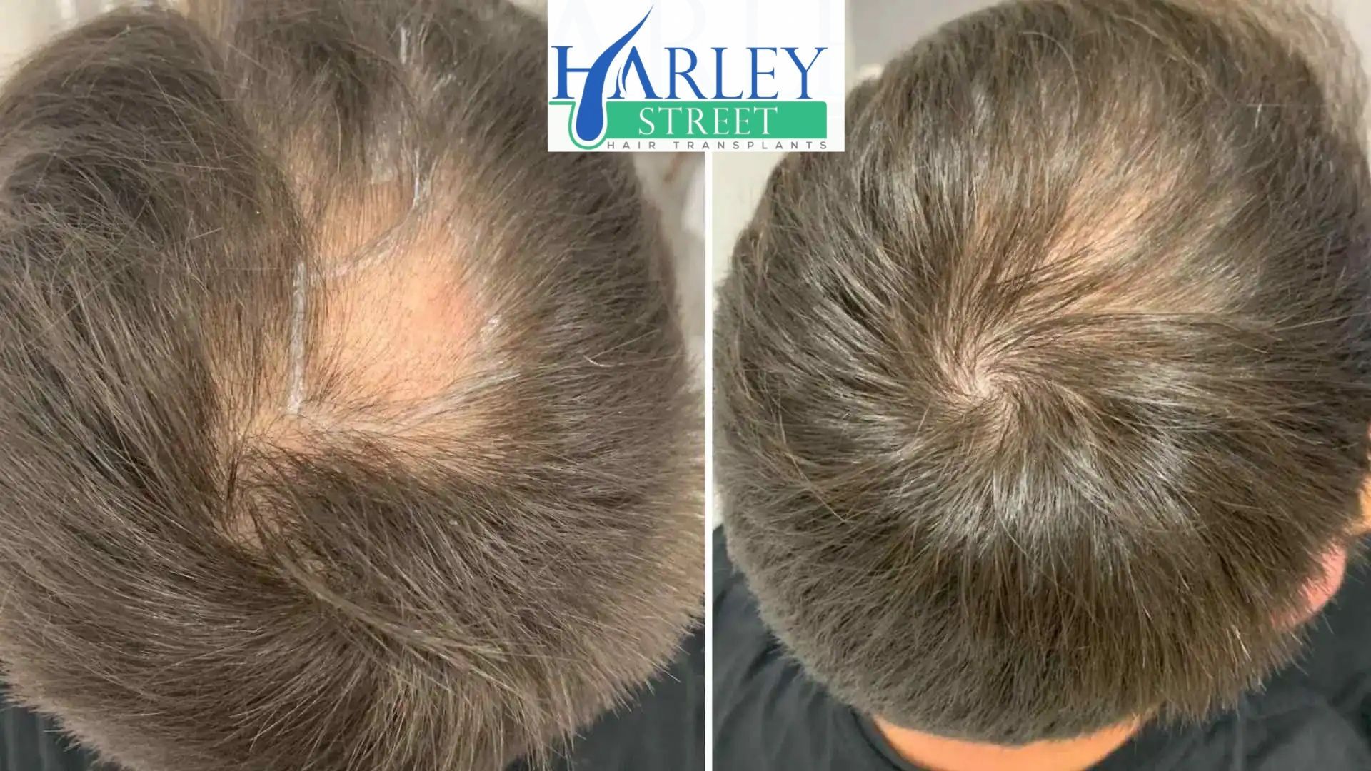 Sam hair transplant before and after results