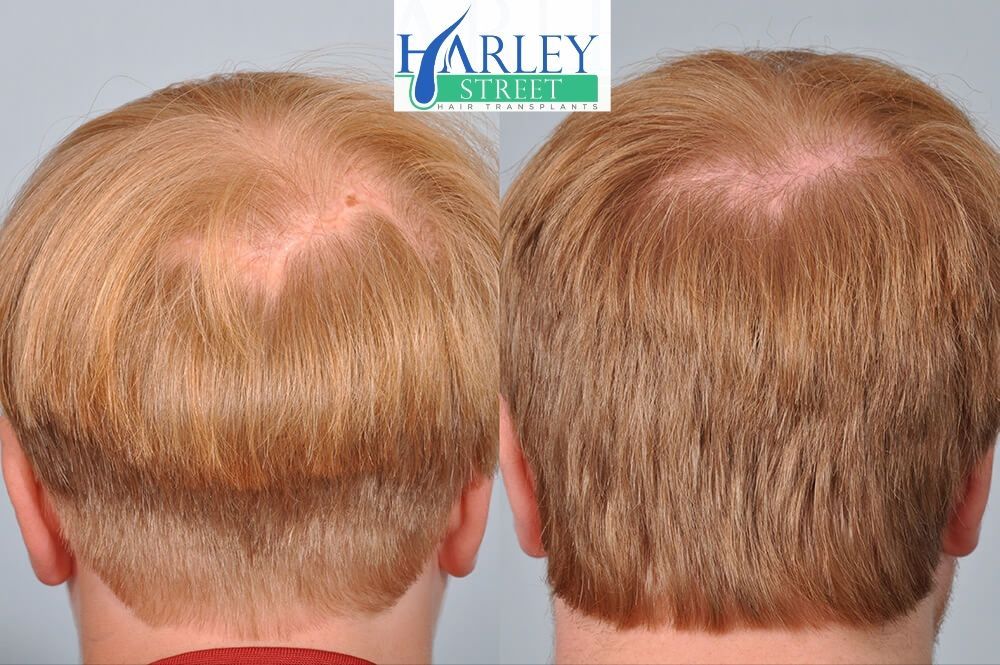 Pete hair transplant before and after results