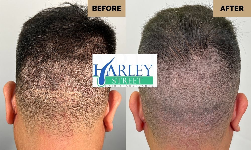 FUT hair transplant donor area