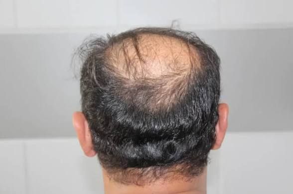 Hair transplant donor area at the back of the scalp