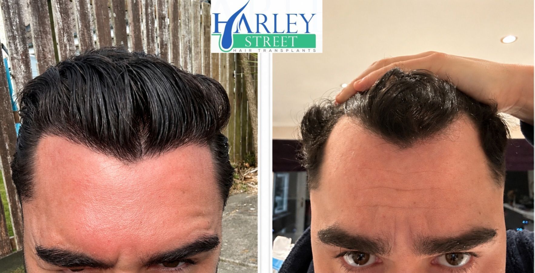 Hair transplant before and after patient result