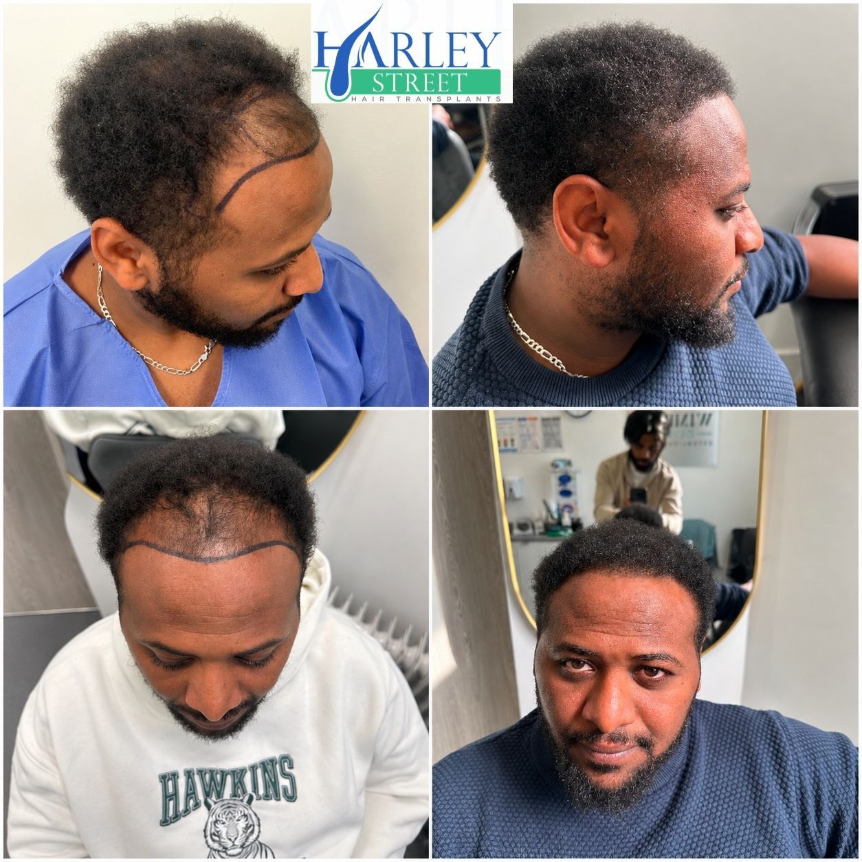 Hair restoration before and after patient result
