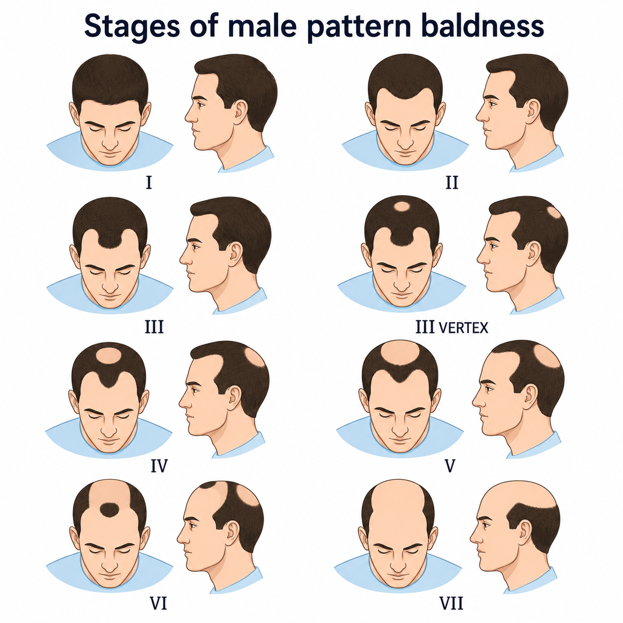 Male pattern baldness stages and progressive male hair loss