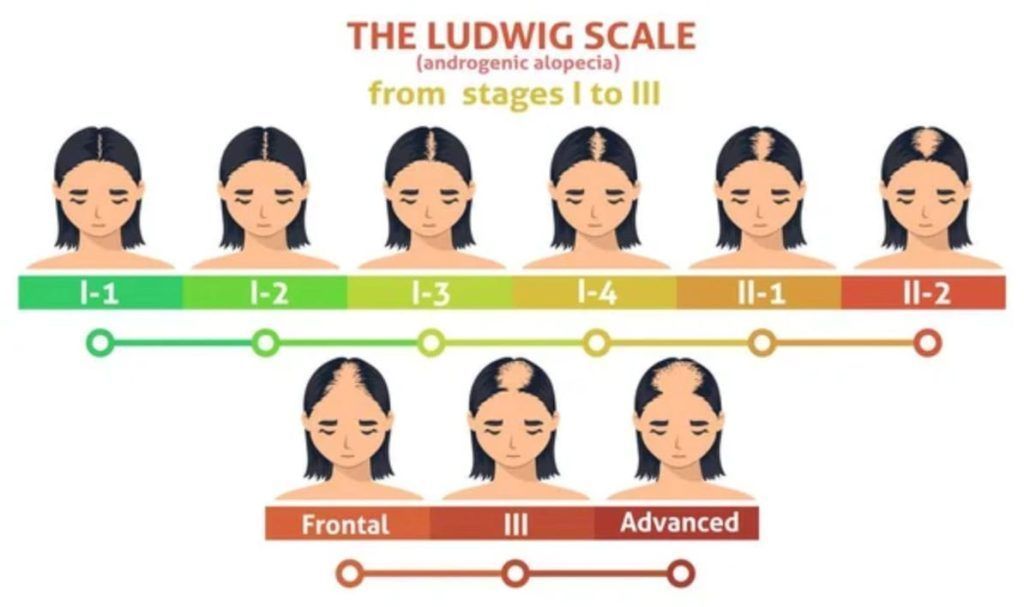 Ludwig Scale showing progressive female pattern hair loss