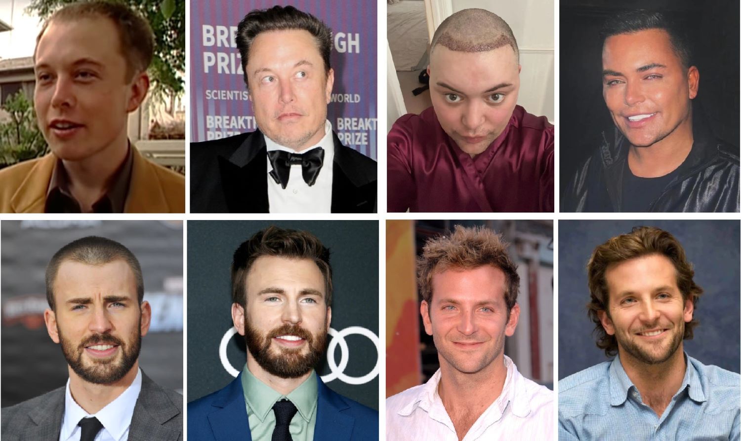 Celebrity hair transplant and hairline comparison collage