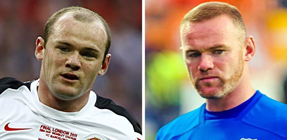 Wayne Rooney before and after hair transplant comparison