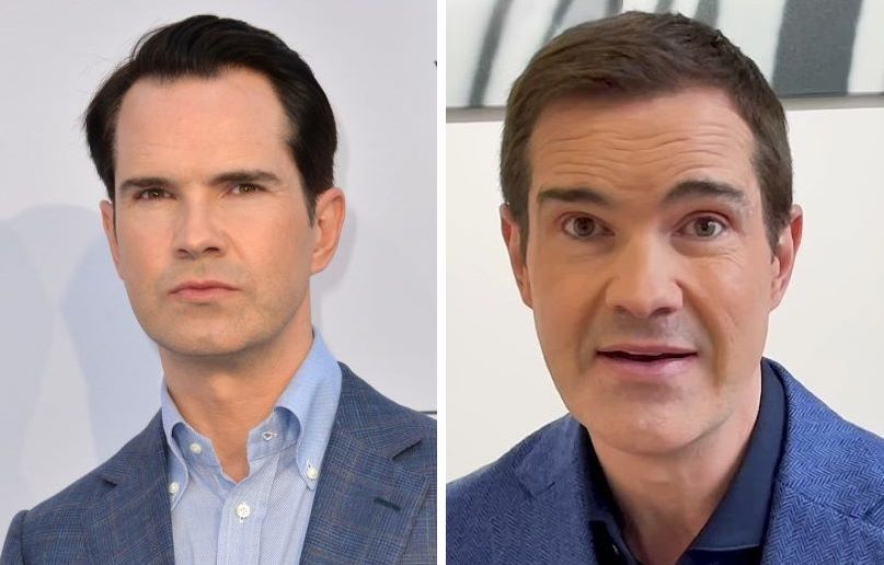 Jimmy Carr before and after hair transplant comparison
