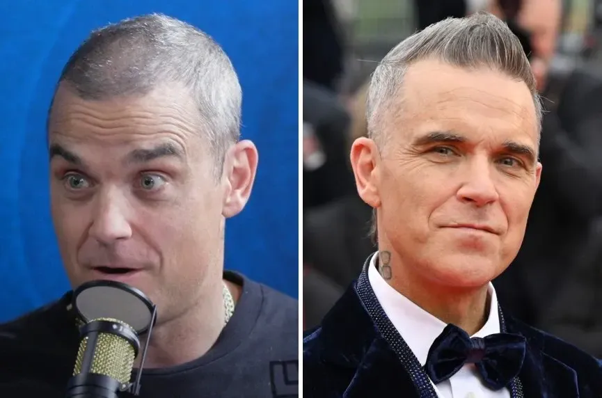 Robbie Williams before and after hair transplant comparison