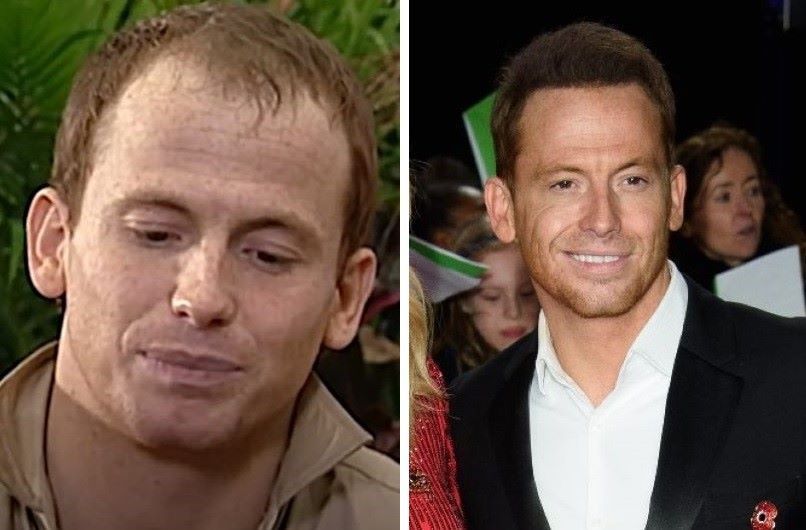 Joe Swash before and after hair transplant comparison