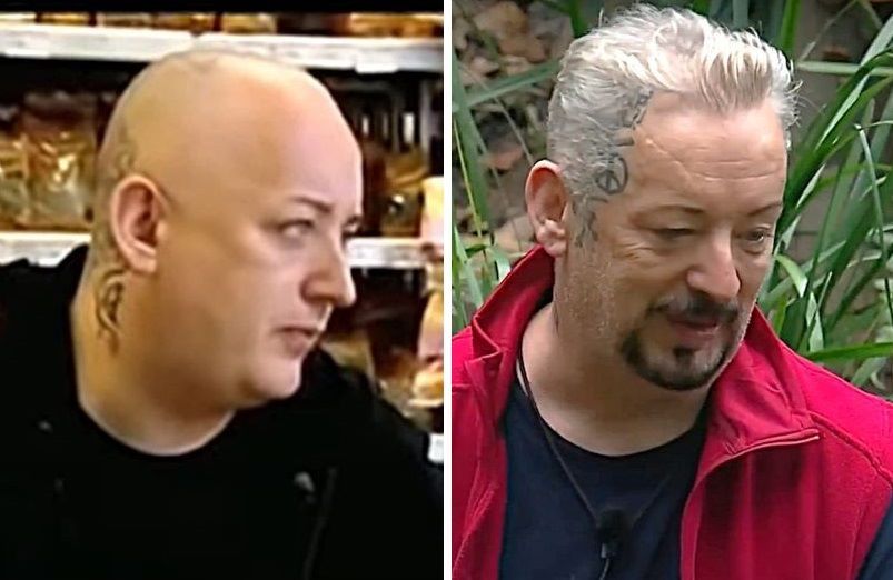 Boy George before and after hair transplant comparison