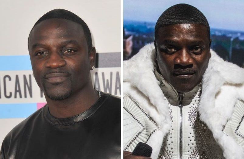 Akon before and after hair transplant comparison