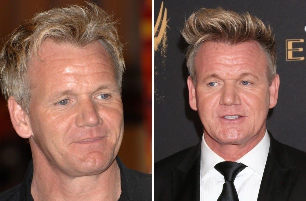 Gordon Ramsay hairline comparison over time