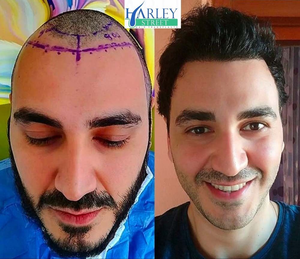 Hair transplant before and after result