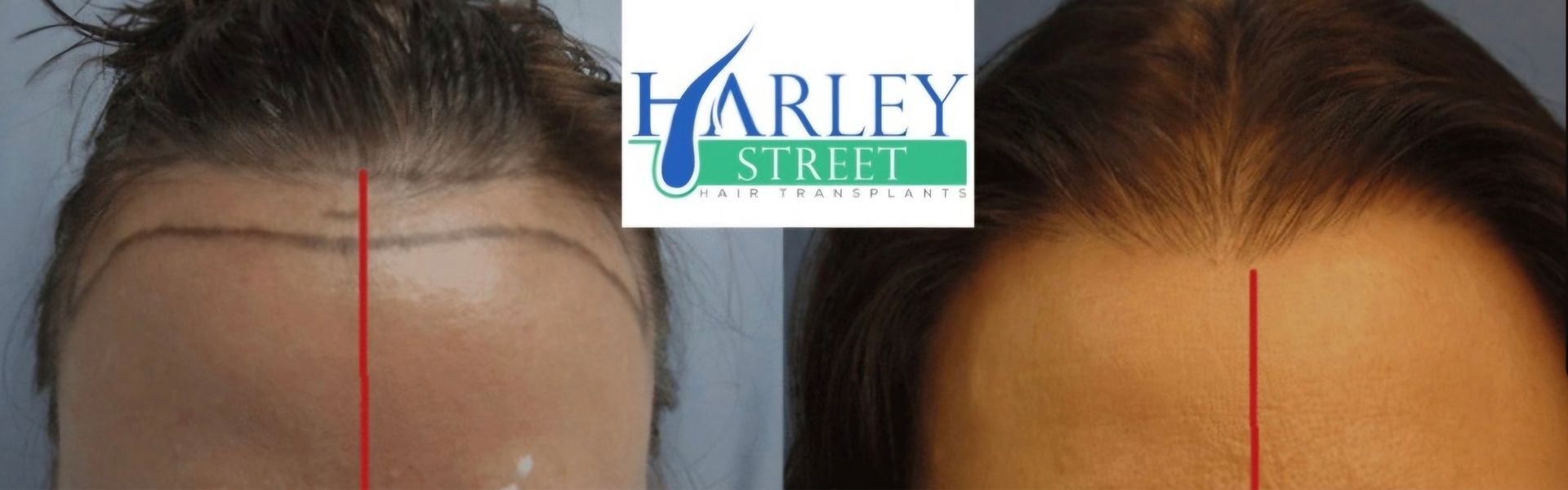 Hair transplant before and after result