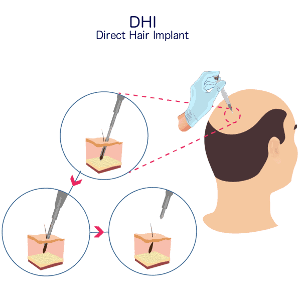 Diagram of DHI direct hair implant on scalp, showing follicle implantation steps with close-up insets.