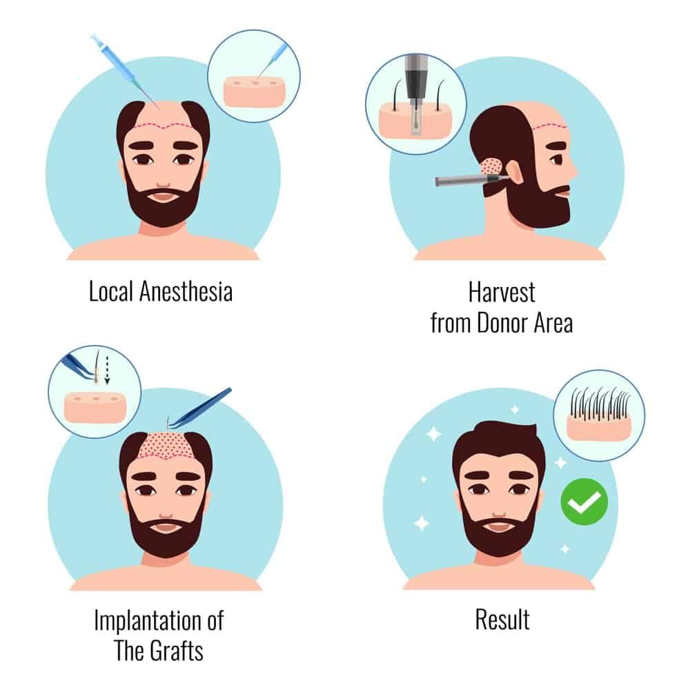 Hair transplant steps: local anesthesia, grafts harvested from donor area, implanted, then result.