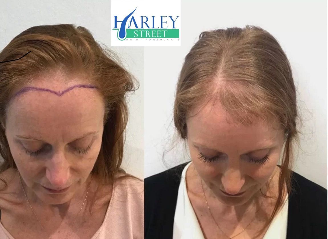 Lyn hair transplant before and after results