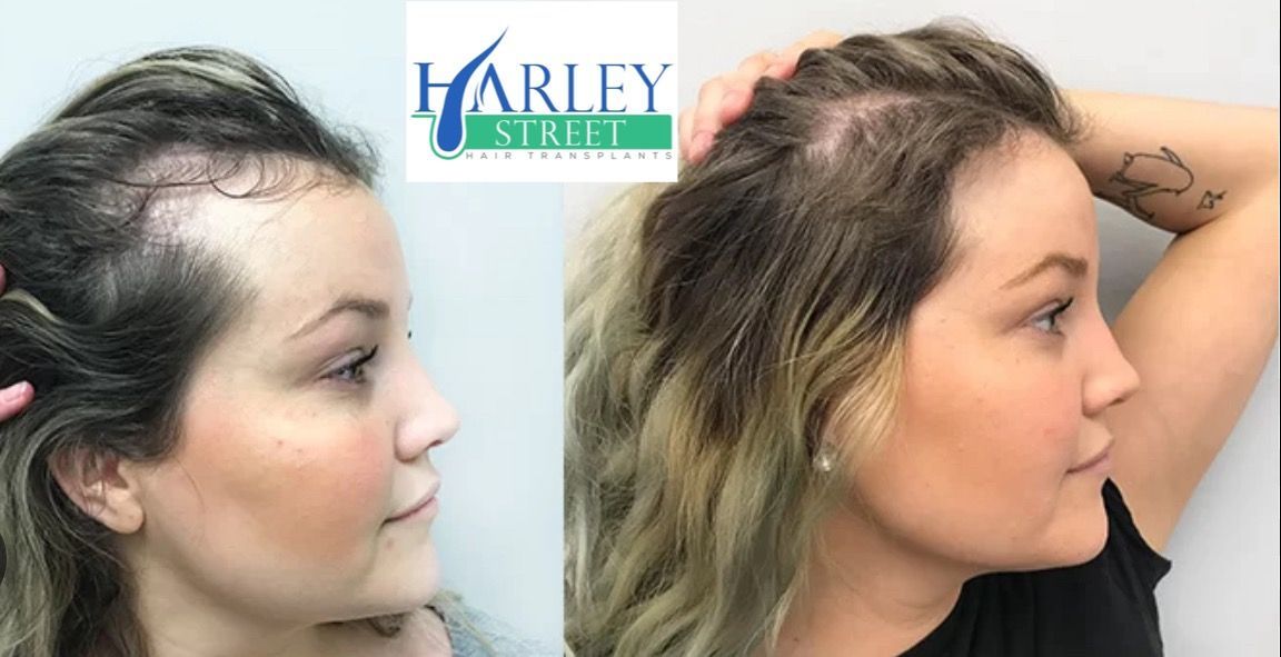 Kelly hair transplant before and after results