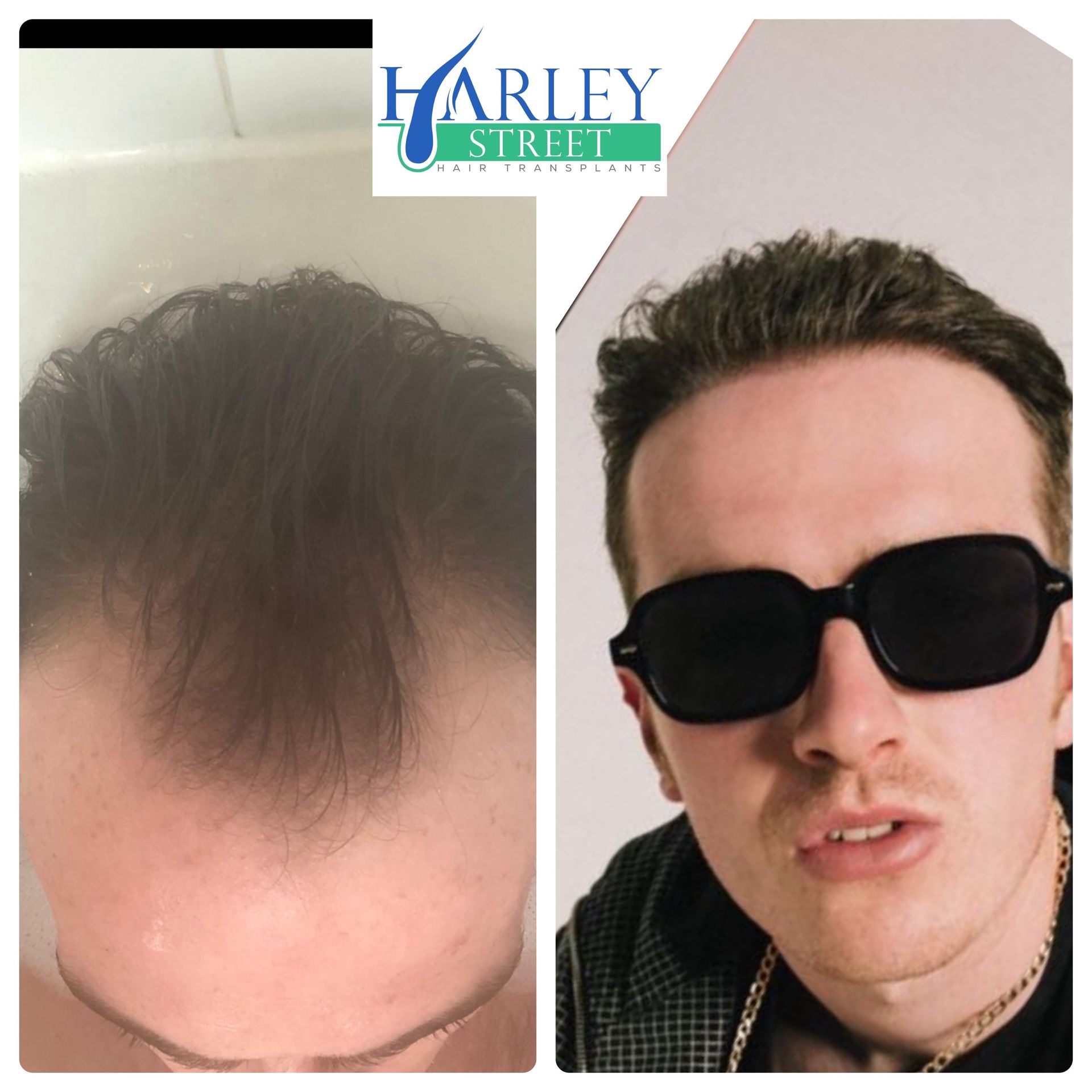 Ryan hair transplant before and after results