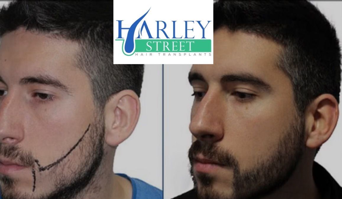 Beard transplant patient result