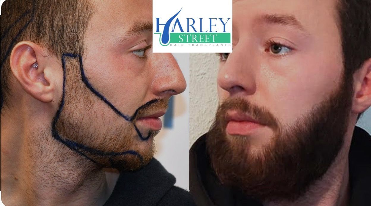 Facial-hair transplant result