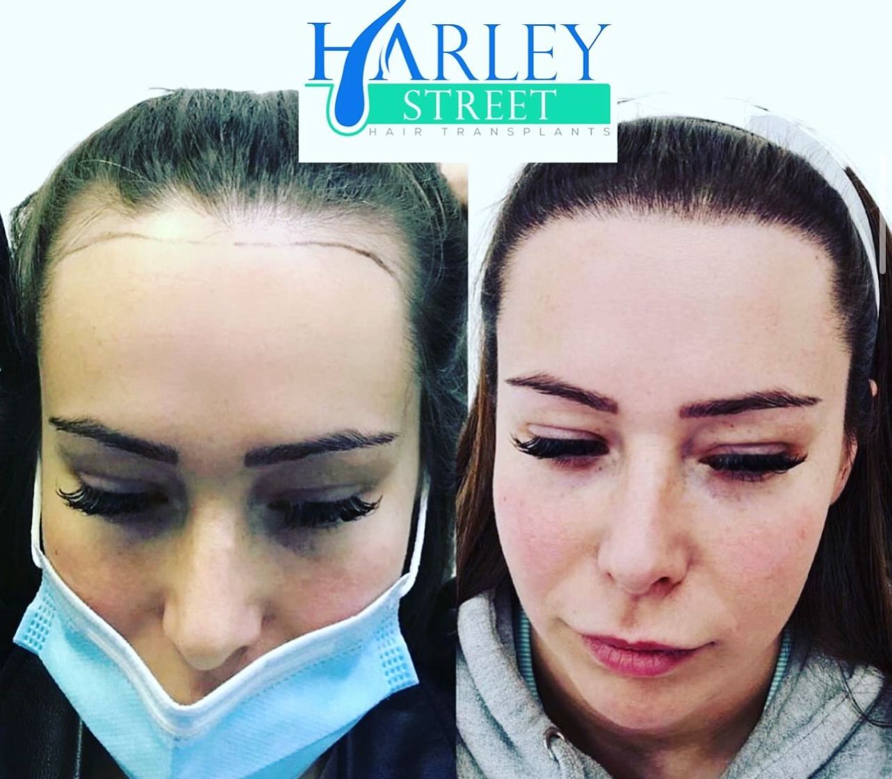 Samantha hair transplant before and after results