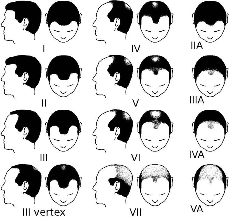 Diagram of male-pattern baldness stages, showing hair loss patterns from front, top, and side views