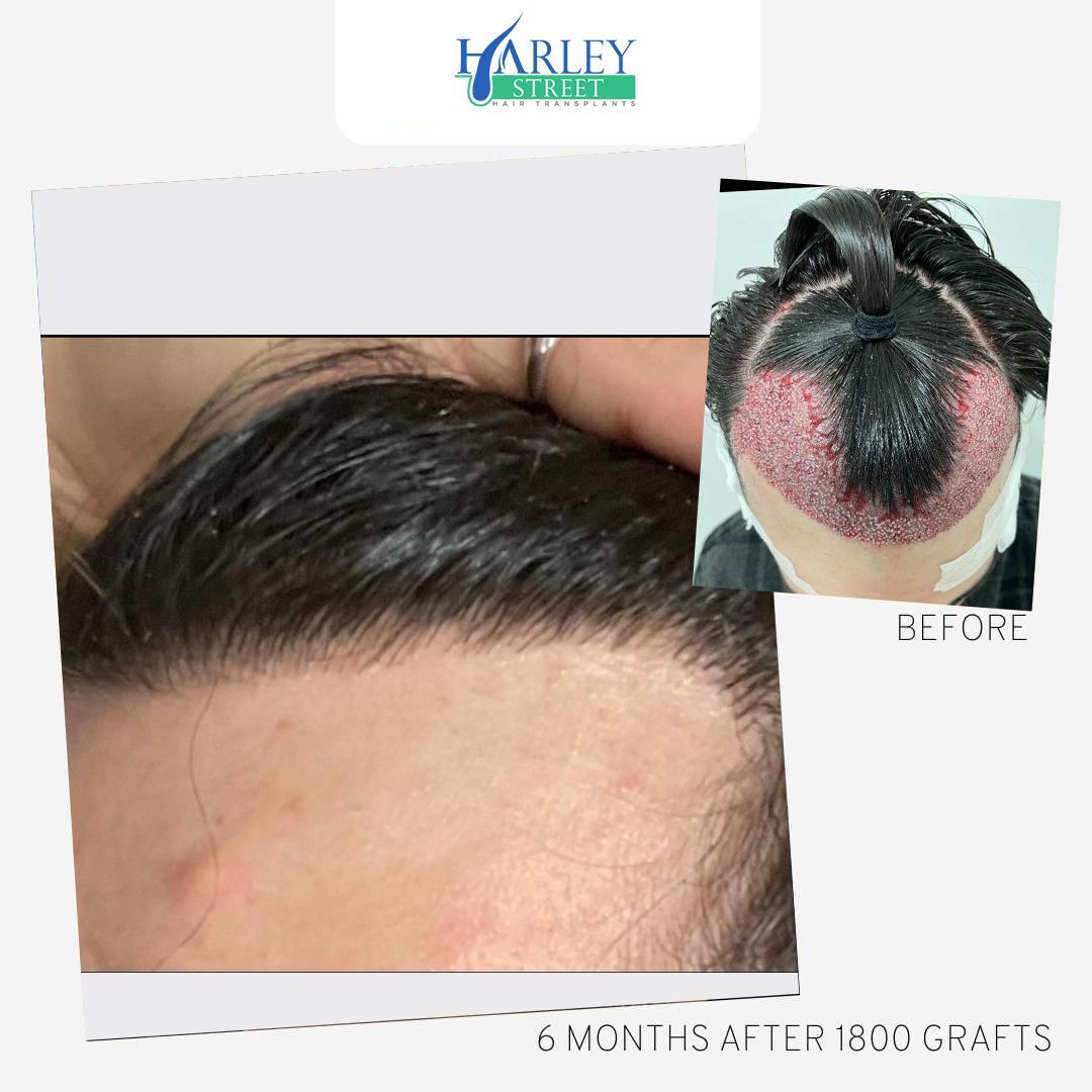 Benjamin hair transplant before and after results
