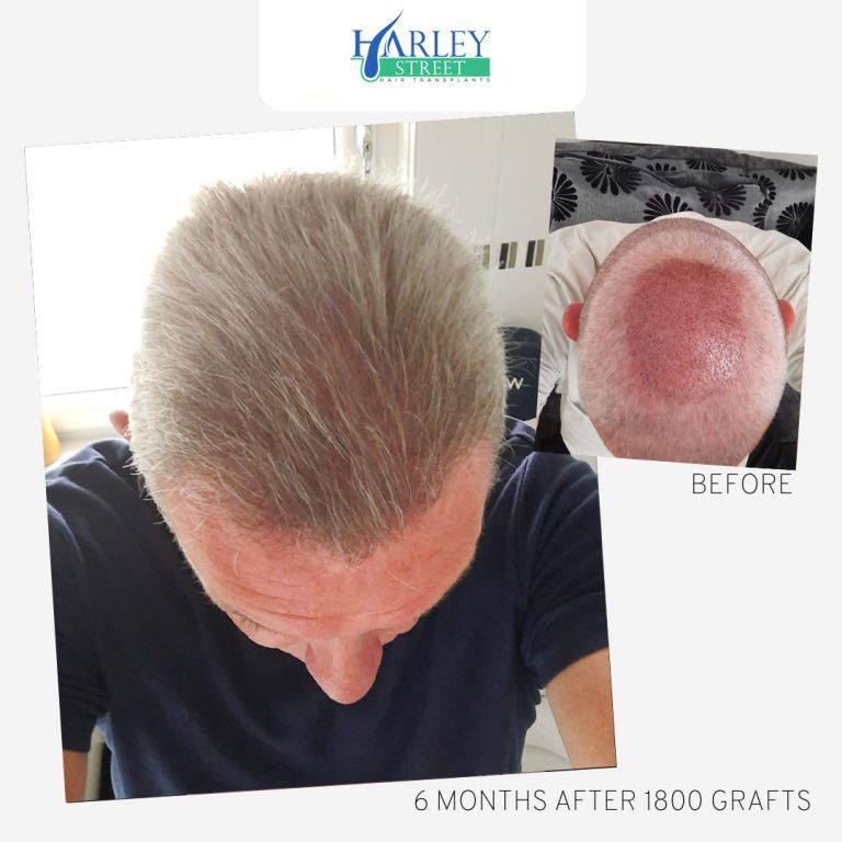 Top-down view of thinning hair, with before-and-after hair transplant inset and 