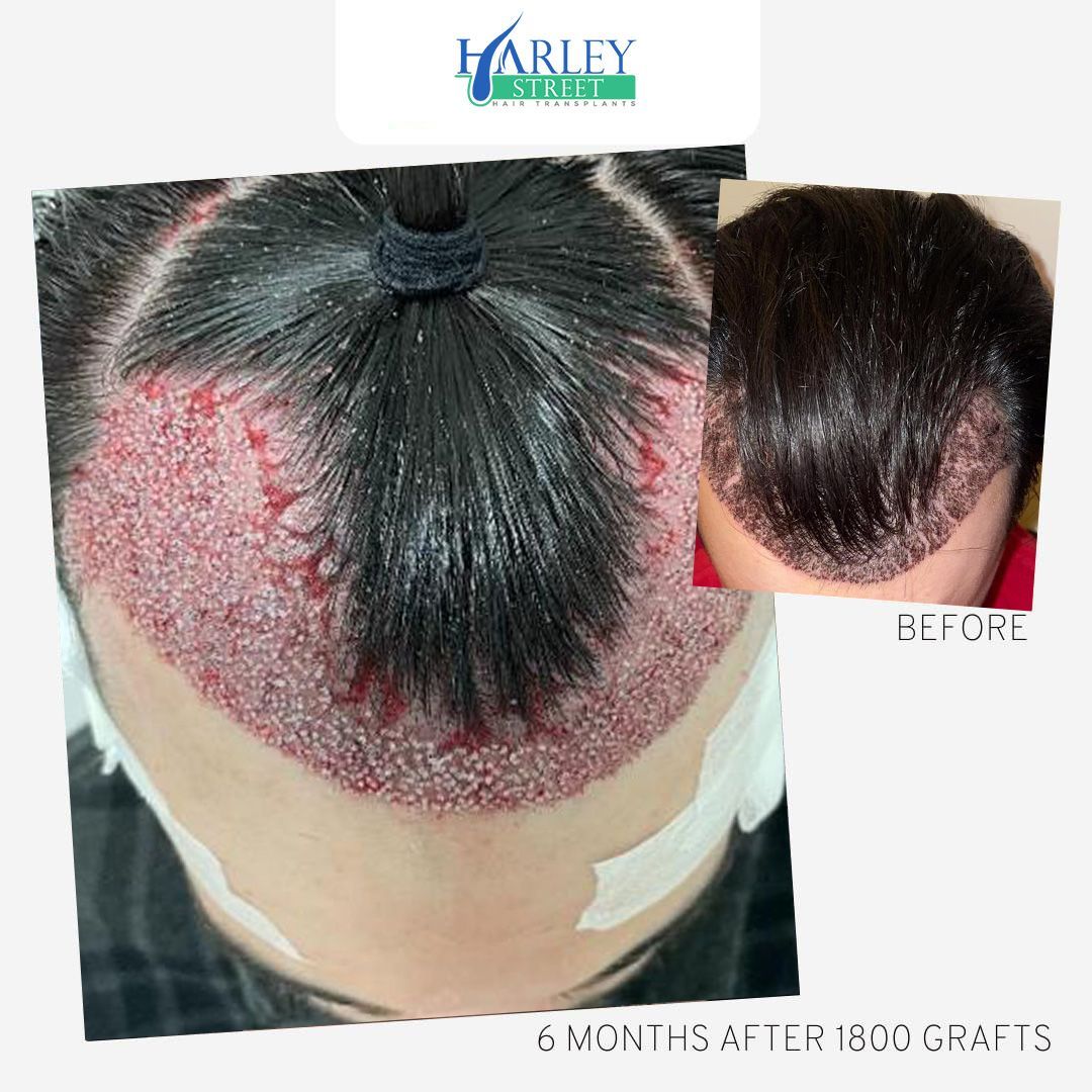 Top view of scalp after hair transplant, with inset before photo and “6 months after 1800 grafts” text