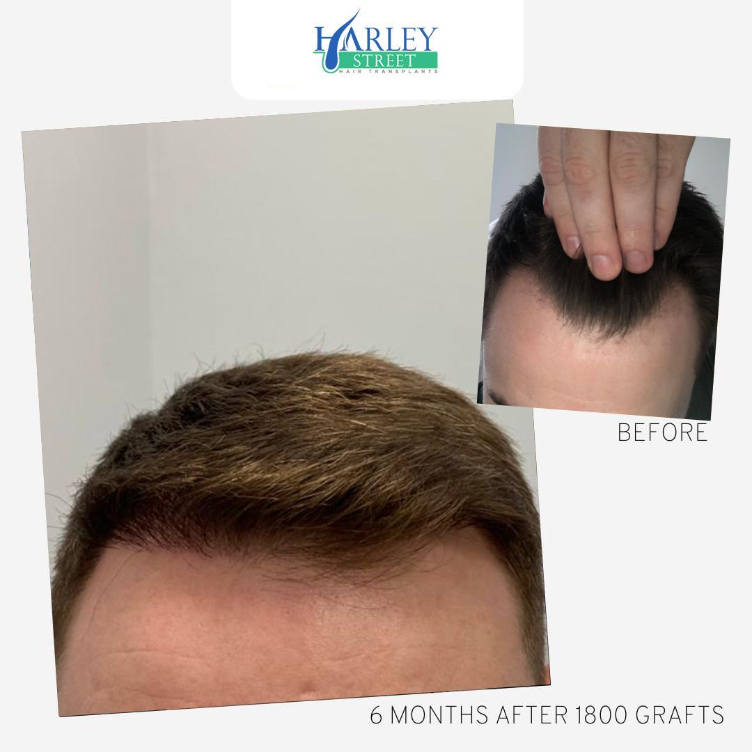 Temple and hairline restoration result four