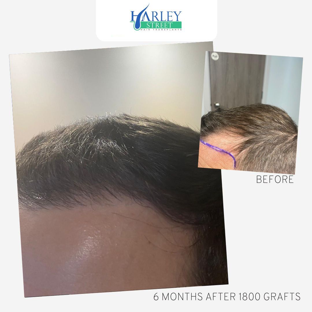 Eddie hair transplant before and after results