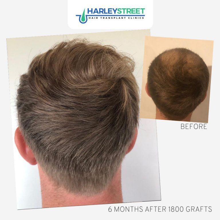 Back of man’s head showing thicker hair, with before inset and “6 months after 1800 grafts” label
