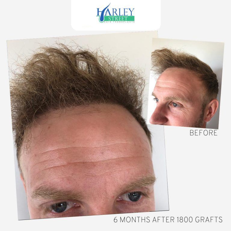 Hair restoration before-and-after collage showing a fuller hairline after 6 months and 1800 grafts