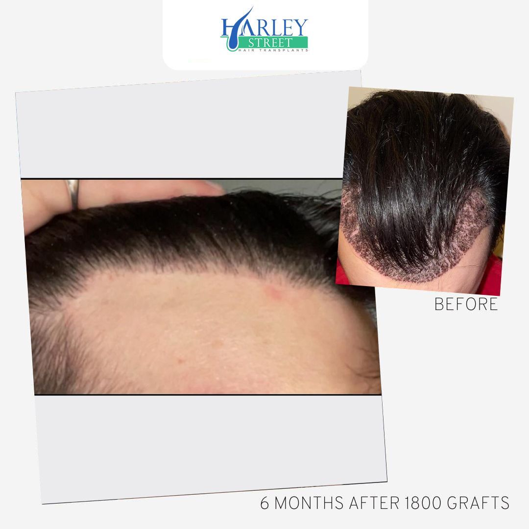 Temple and frontal corner hair transplant result