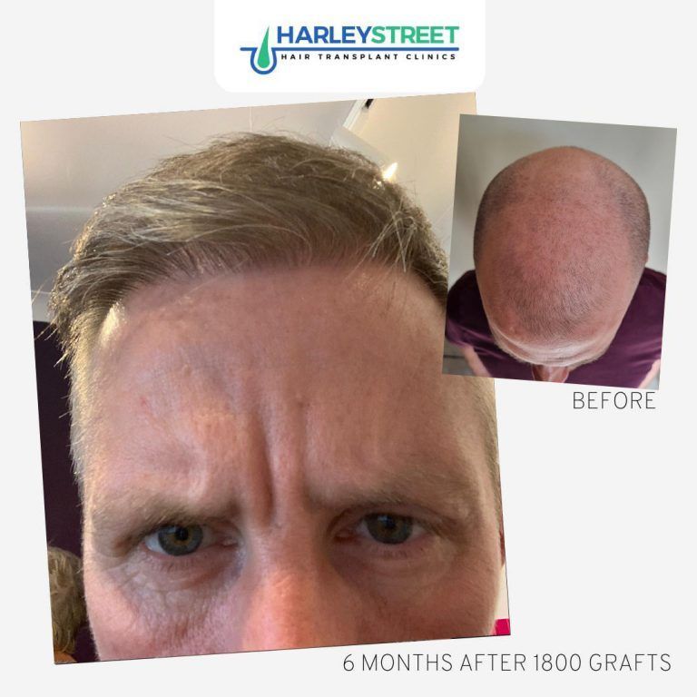 Before-and-after hair transplant results: close-up of thinning hair, with inset bald crown labeled “before.”