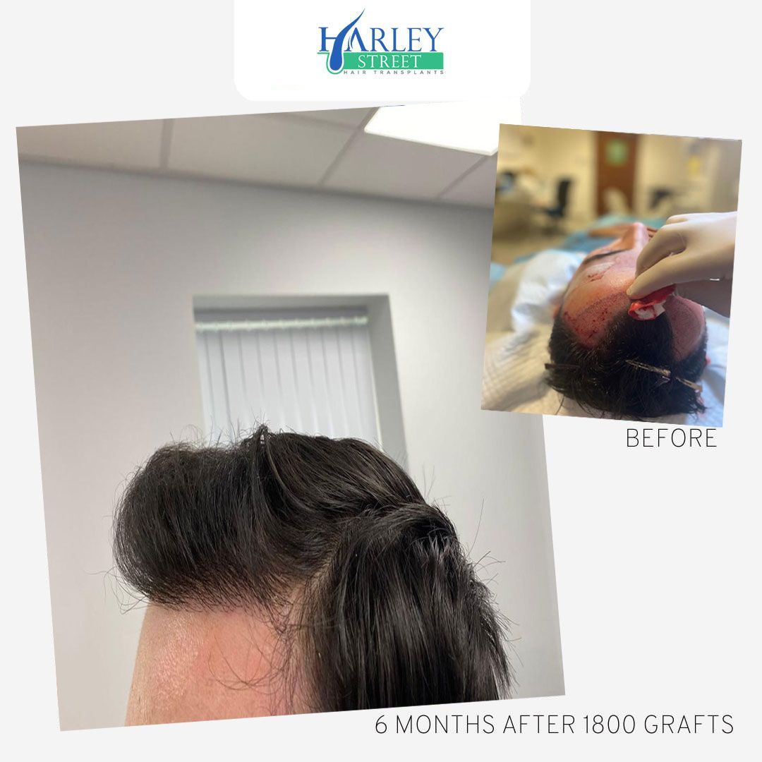 Frontal hairline and temple restoration
